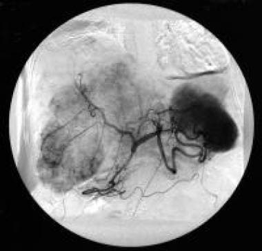 Celiac-axis angiography (arterial phase) of a pati