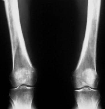 Radiograph in a patient with long-standing bronchi