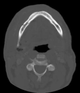 icd 10 code for left mandibular angle fracture