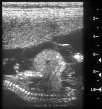 Sagittal antenatal scan on a 13- or 14-week-old fe