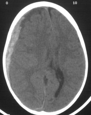 Acute subdural hematoma. Note the bright (white) i