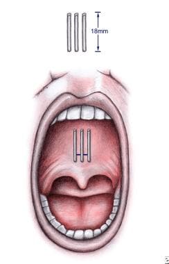 Illustration of the intraoral placement of 3 pilla