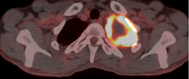 A 50-year-old man with Pancoast tumor. A PET scan 
