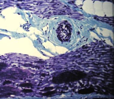 Spinal muscle atrophy, Werdnig-Hoffman disease. Ma