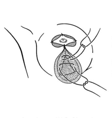 Demonstration of partial inset of superior pedicle
