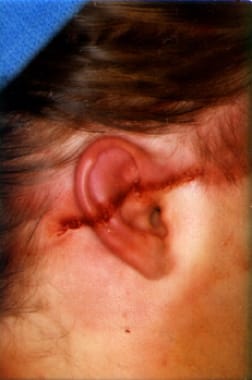 Ear Reconstruction and Salvage Procedures: History of the Procedure
