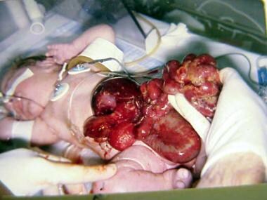 In this baby with gastroschisis, bowel is uncovere
