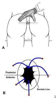 Anal fissure at posterior midline