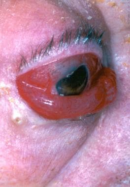 Type-D caroticocavernous fistula: the eye demonstr