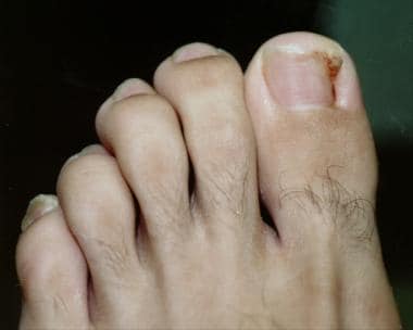 Appearance of typical ingrown toenail. 