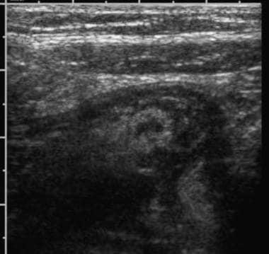 Ultrasonographic examination of the right lower qu