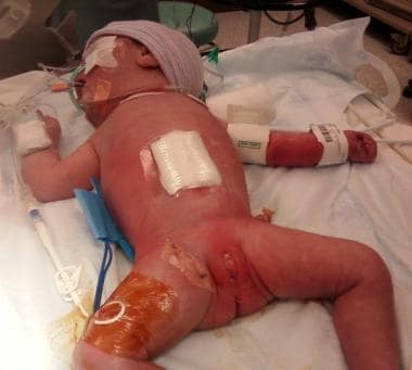 Pediatric omphalocele and gastroschisis (abdominal