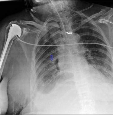 A case of misplaced endotracheal tube. Note the po