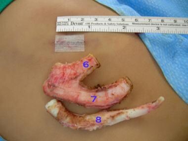 Incision should be as small as possible without je