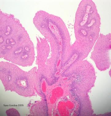 Human papillomavirus (HPV). Verrucae and papilloma