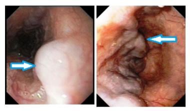 Endoscopic pictures of esophageal varices. Courtes