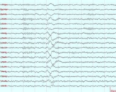 This shows a K complex, typically a high-amplitude