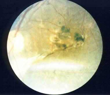 Retinal scar and uveal effusion in Hansen disease.