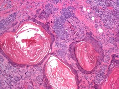 Myoepithelial Carcinoma. Myoepithelial carcinoma (