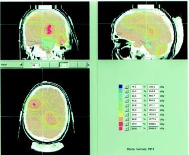 Intensity-modulated radiation therapy (IMRT) for a