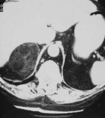 Contrast-enhanced CT in a 72-year-old woman reveal