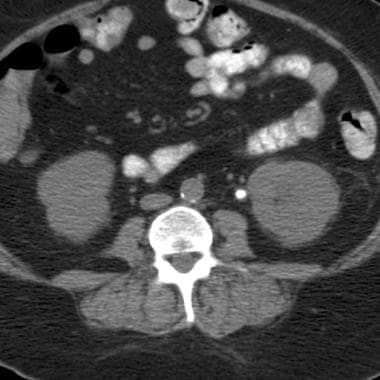 Nonenhanced CT image shows an obstructing left pro