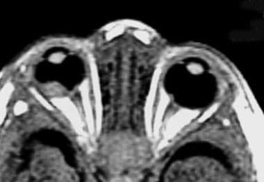 Axial T1-weighted contrast-enhanced MRI in an infa