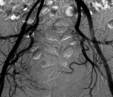 Postembolization angiogram shows a reduction in tu
