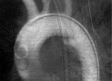 Aorta, trauma. Left anterior oblique (45°) angiogr