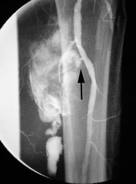 Unsubtracted left lower extremity angiogram (same 