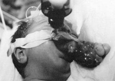 Newborn with epignathus. The patient was intubated