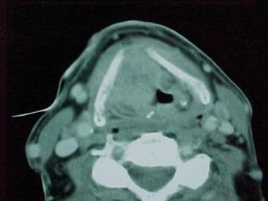 Erosion of the thyroid cartilage by the tumor seen
