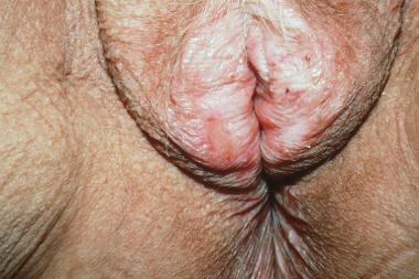 More advanced vulvar lichen sclerosus; eroded area