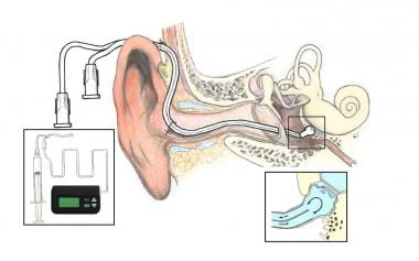 Steroid injection in ear for tinnitus