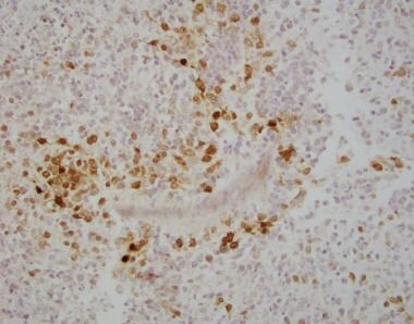 Pathology of Embryonal Tumors. Tumor cells in cent