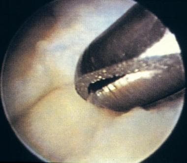 Arthroscopic debridement in a class IA tear. The f