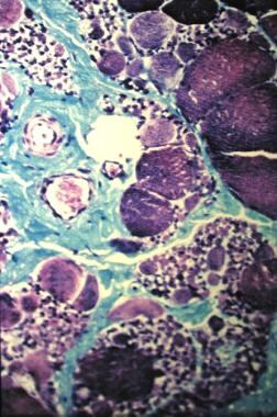 Spinal muscle atrophy, Kugelberg-Welander disease.
