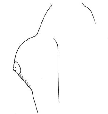 Immediate postoperative appearance, demonstrating