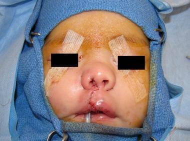 Cleft nose repair at the time of cleft lip repair
