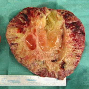 Cross-section of a clear cell carcinoma of the ova