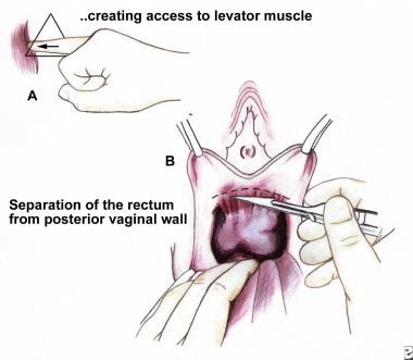 Does cystocele and rectocele repair surgery hurt?