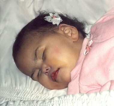 Pictured is an infant with sulfite oxidase deficie