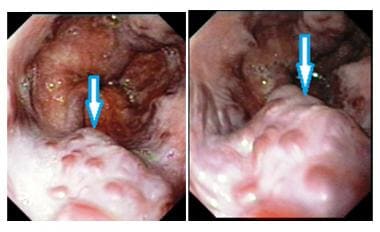 Esophageal varices with cherry red spots. These sp