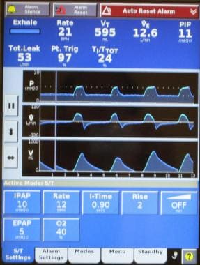 Screen shot of ventilator graphics and information