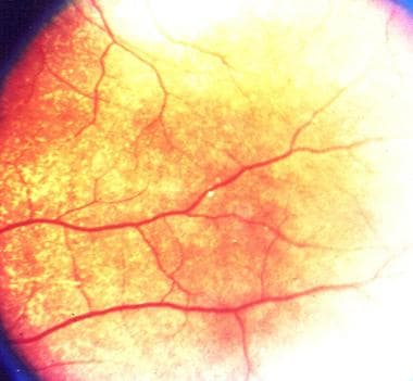 Retinal pearl in a patient with Hansen disease. 