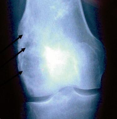AP radiograph of the knee demonstrating a tumor ar