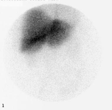 Hepatobiliary (HIDA) scan showing liver uptake of 