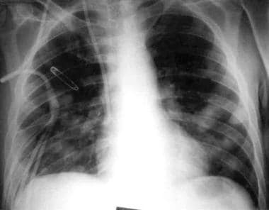Chest radiograph showing multiple pulmonary nodule