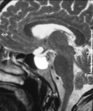 Sagittal T2-weighted MRI shows a hyperintense cyst
