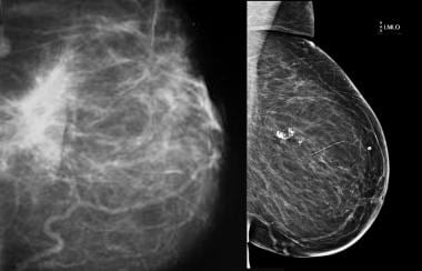 Traumatic fat necrosis. Mammogram shows traumatic 
